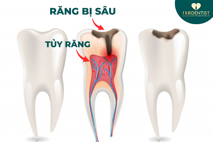 dieu-tri-tuy-rang-bang-cong-nghe-moi-tai-umi-dentist-1