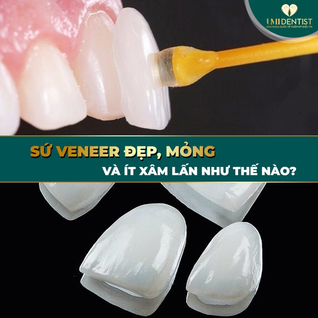 dan-su-veneer-sieu-mong-phuong-phap-tham-my-toan-dien-tai-umi-dentist-01